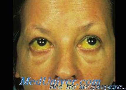 геморрагическая лихорадка с почечным синдромом