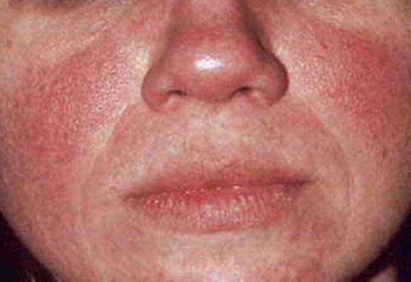 Полицитемия