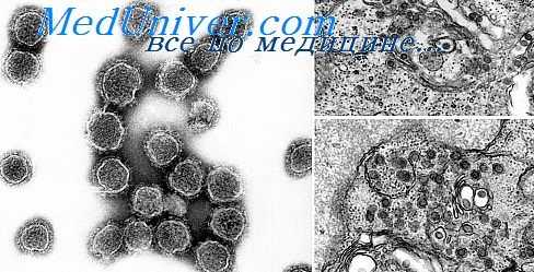 калифорнийский энцефалит