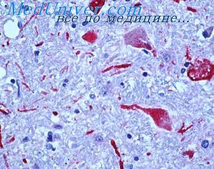 калифорнийский энцефалит