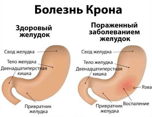 Что такое болезнь Крона