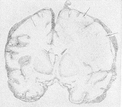 Рис. 1. Фронтальный срез головного мозга больного, умершего от геморрагического лейкоэнцефалита: белое вещество справа более отечное, усеяно мелкими петехиальными кровоизлияниями (указаны стрелками), прилежащие участки коры нечетко очерчены.