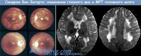Лейкоэнцефалит Шильдера
