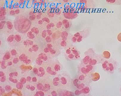 энцефалит после вакцинации