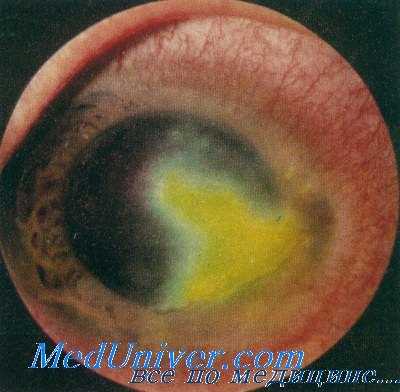 кератит при малярии