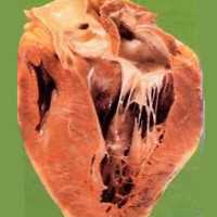 Миокардиодистрофия