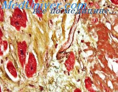 миокардиодистрофия