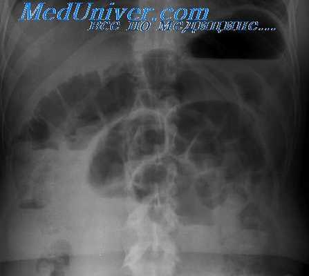 лейомиосаркома