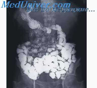 опухоль кишечника