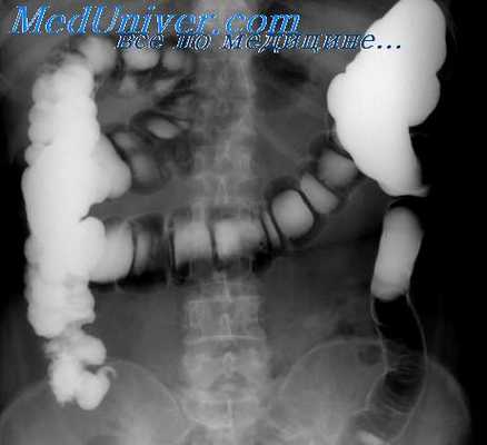 рак подвздошной кишки