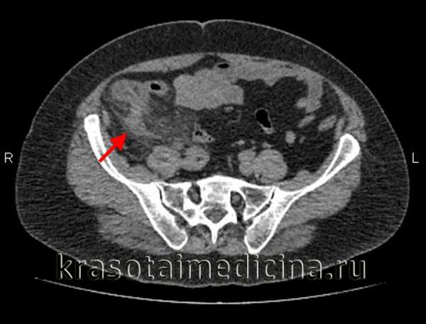 КТ ОБП. Выраженное утолщение червеобразного отростка до 1,5 см с наличием воспалительных изменений периаппендикулярной клетчатки