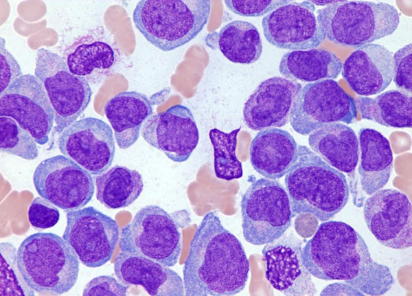 Острый миелоидный лейкоз