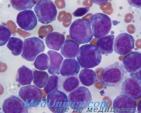 острый лейкоз