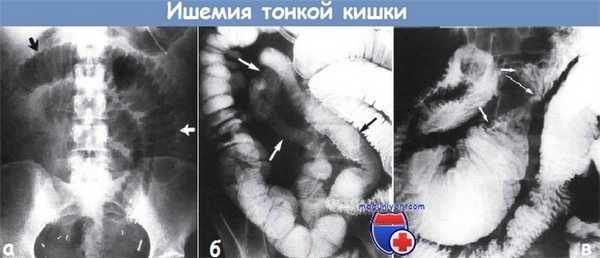 Ишемия тонкой кишки