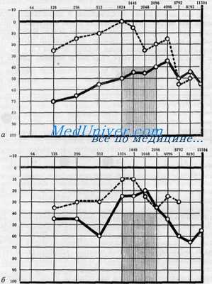 отосклероз