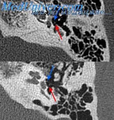 отоспонгиоз