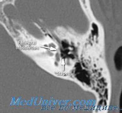 отосклероз