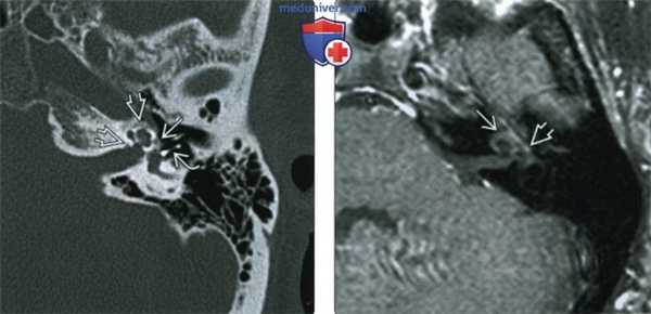 КТ, МРТ при отосклерозе
