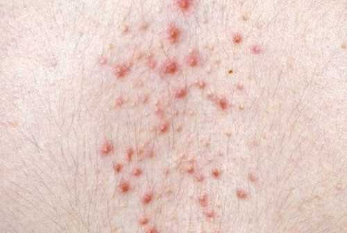 Акнеподобная сыпь 2.jpg