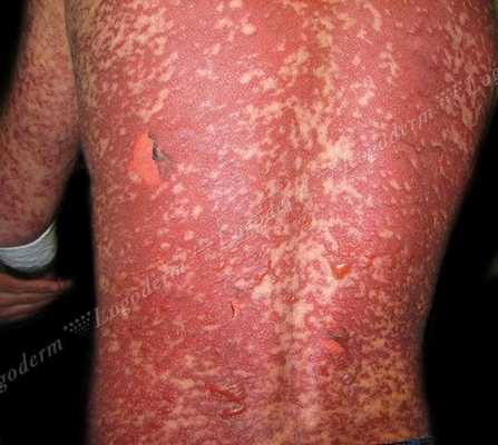 Синдром Лайелла.jpg