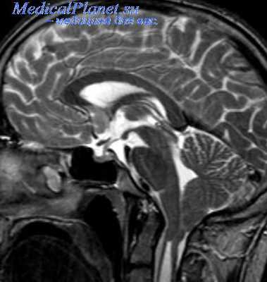 поражение лицевого нерва