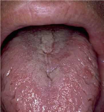 Складчатый язык