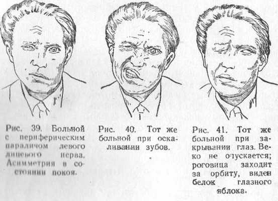 Паралич лицевого нерва