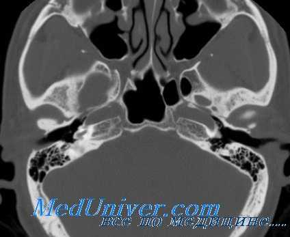 отосклероз