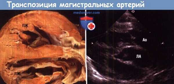 Транспозиция магистральных артерий