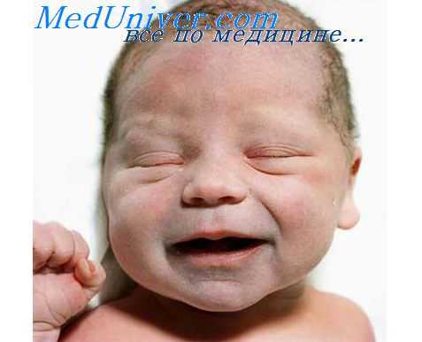 цереброкардиальный синдром у ребенка