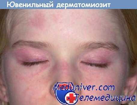 ювенильный дерматомиозит у детей