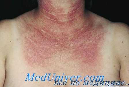 ювенильный дерматомиозит