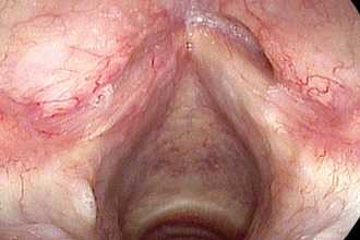 туберкулез