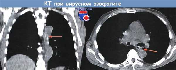 Острый эзофагит