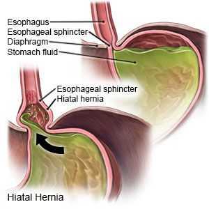 Рефлюкс-эзофагит