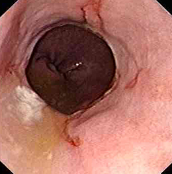 Эрозии пищевода как следствие рефлюкса (эндоскопия)