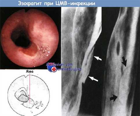 Острый эзофагит