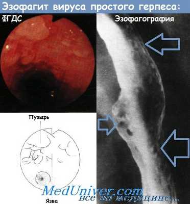 Эзофагит вируса простого герпеса