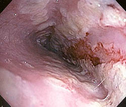 Кандидозный эзофагит (эндоскопия)