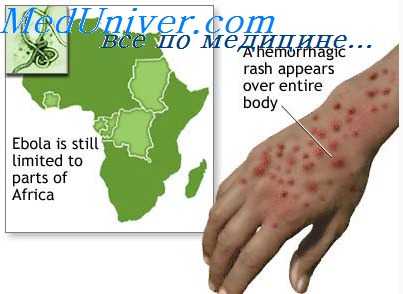 крымская геморрагическая лихорадка