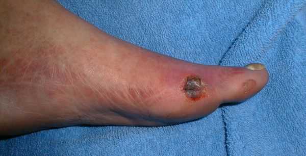 Ишемическая гангренозная стопа