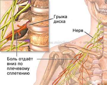 При сдавлении нерва грыжей диска на шейном уровне позвоночника у больного возникает чувство боли и прострела током по руке, идущее от плеча до пальцев кисти.