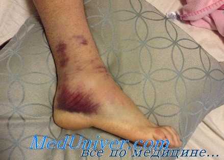 растяжение голеностопного сустава