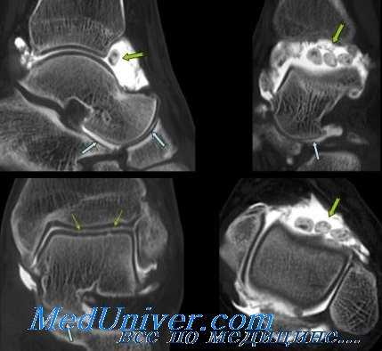 растяжение голеностопного сустава
