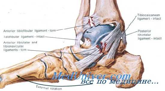 растяжение голеностопного сустава