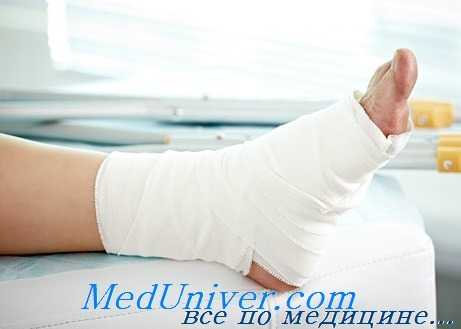 лечение растяжений голеностопного сустава