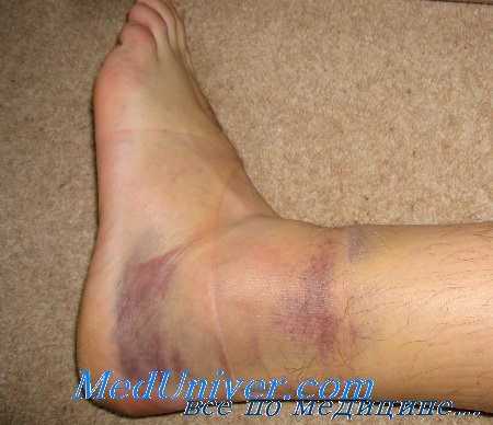 растяжение голеностопного сустава