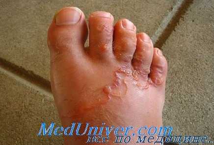 шистосомоз глаз