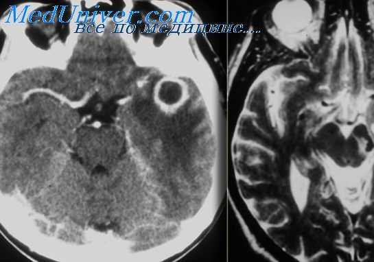 субдуральный абсцесс