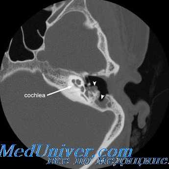пахименингиты